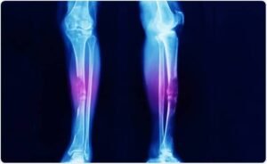 Bone Cancer